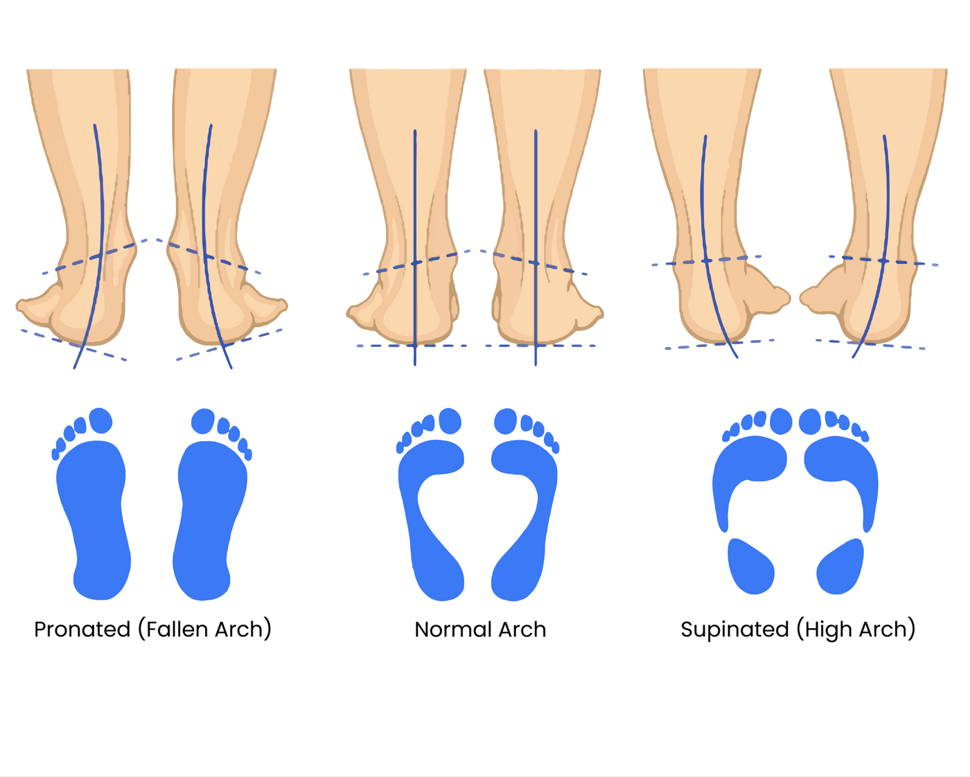 feet posture comparison chart fallen arch versus normal arch vs high arch